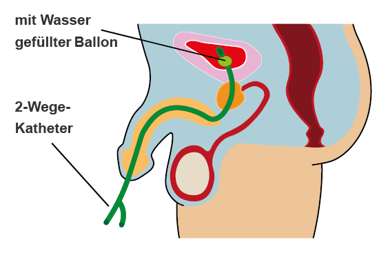 Anatomische Darstellung eines Blasenkatheters